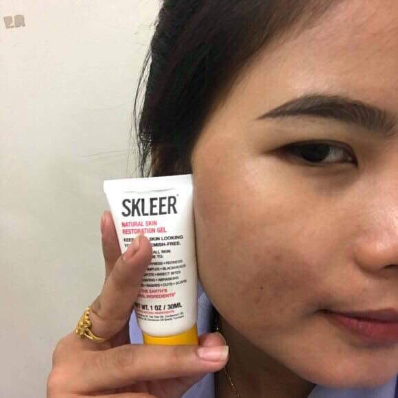 Abrasions Face Traffic Accident After SKLEER
