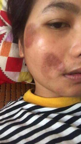 Abrasions Face Traffic Accident Before SKLEER