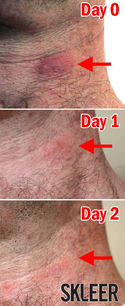 Spider Bite Pictures - What They Look Like, How To Treat Symptoms