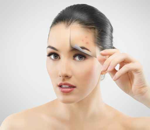 Acne Treatment