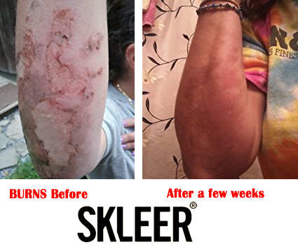 Burns Before and After with SKLEER