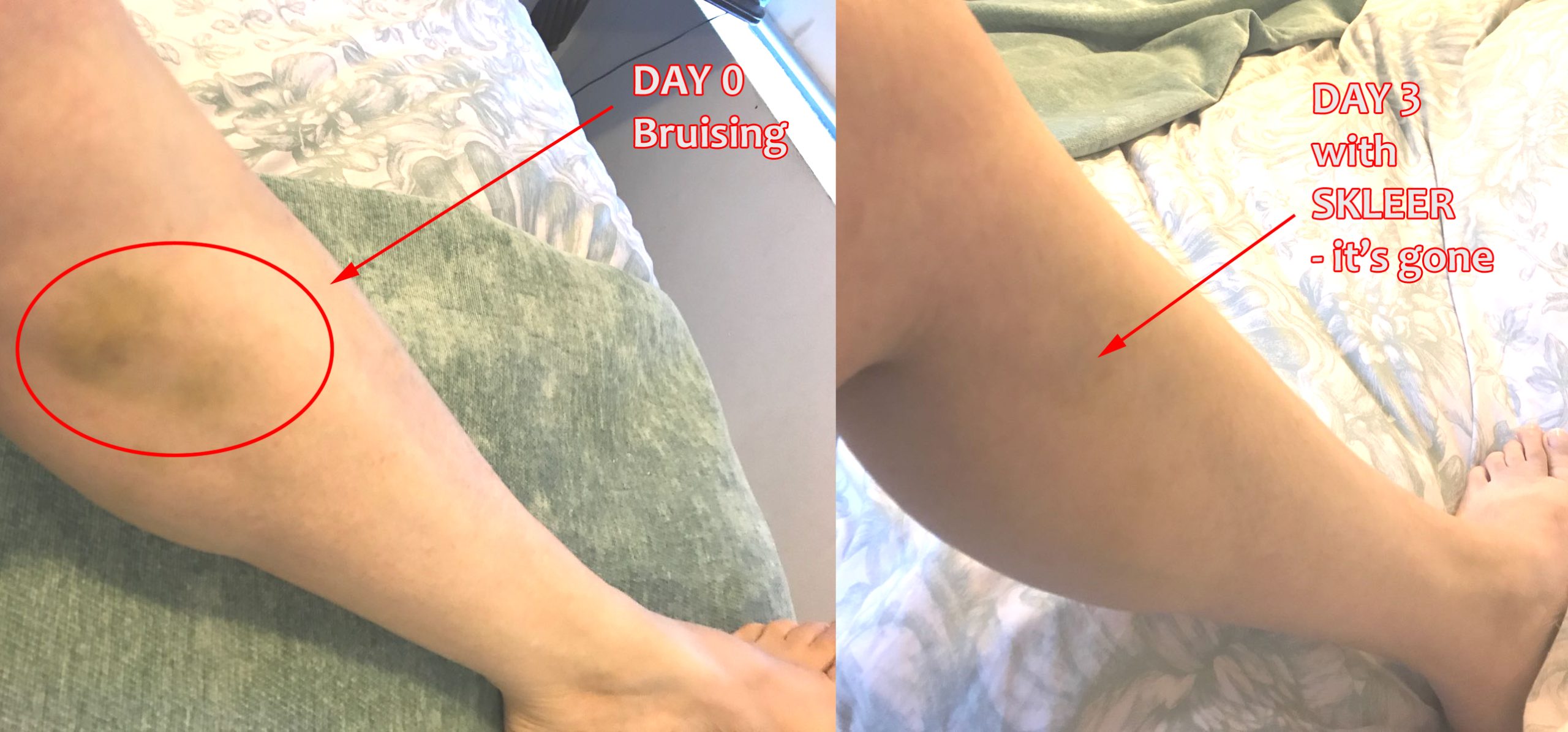Bruising Before And After With SKLEER