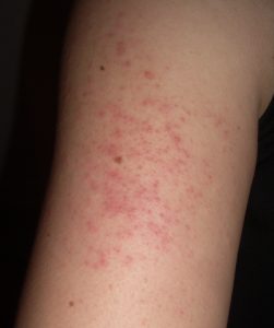 Rash on deals upper arm